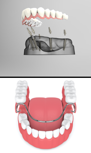 denture implants method