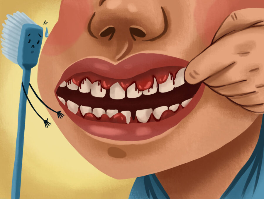 graphic of person with early signs of gum disease with swollen, bleeding gums.