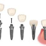 components of dental implant, implant restoration, dental crown