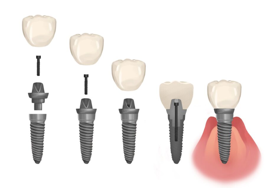 components of dental implant, implant restoration, dental crown